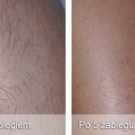 depilacja laserowa