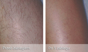 depilacja laserowa, usuwanie owłosienia
