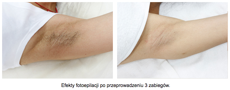 depilacja-laserowa-pacha