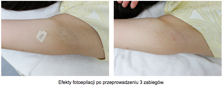 depilacja-laserowa-rece