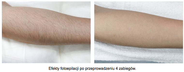 depilacja-laserowa-reka