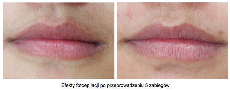 depilacja-laserowa-wasik