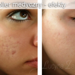 mezoroller medyczny