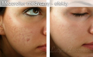 mezoroller medyczny efekty