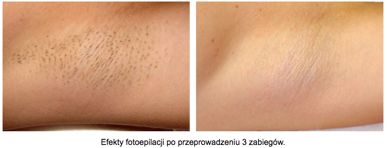 usuwanie-owlosienia-pacha