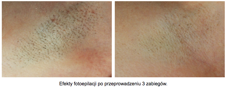 usuwanie-wlosow-pod-pachami